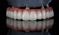 All-on-X Dental Implants Procedure