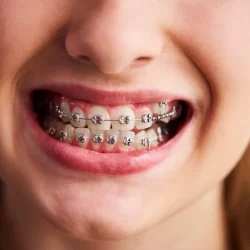 what-are-the-types-of-braces