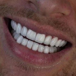 what-are-veneers-819x1024